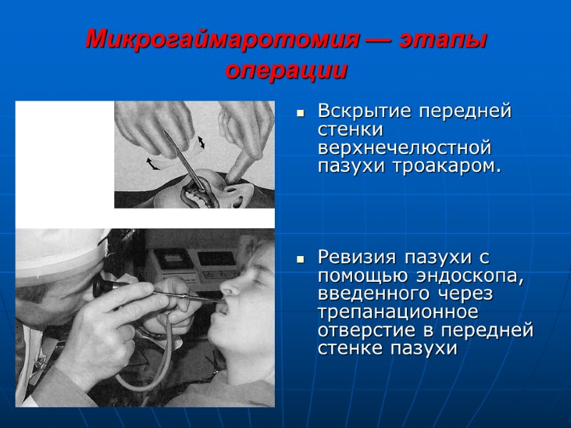 Микрогаймаротомия — этапы операции Вскрытие передней стенки верхнечелюстной пазухи троакаром.    Ревизия